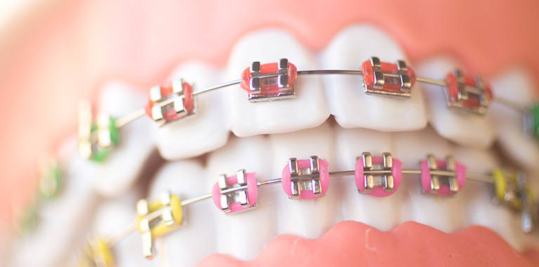 Columbus In Orthodontics Columbus Dental Solutions