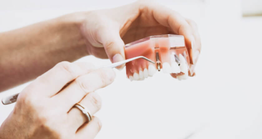 hands holding and demonstrating dental implants