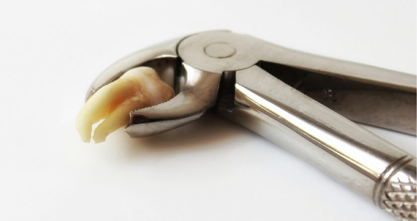 extracted molar in the clasp of dental pliers