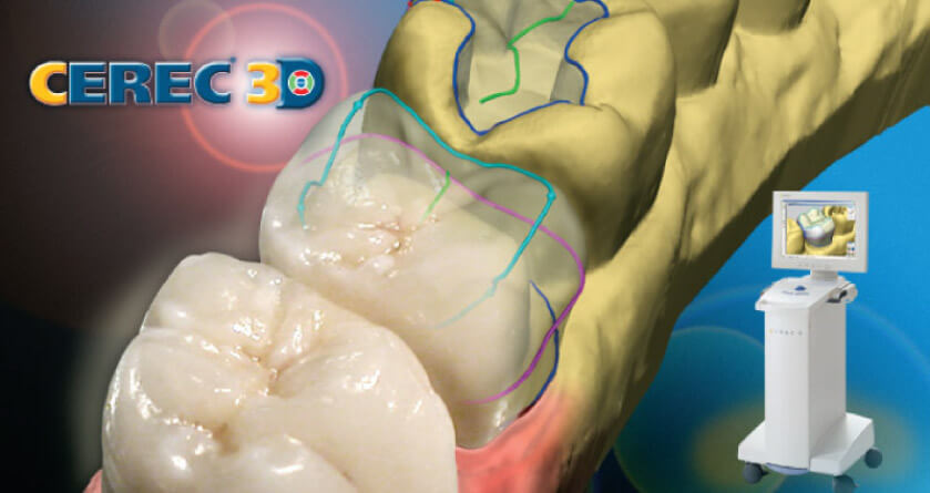 CEREC dental crowns technology