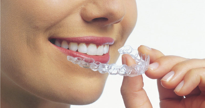 clear aligners for orthodontic treatments