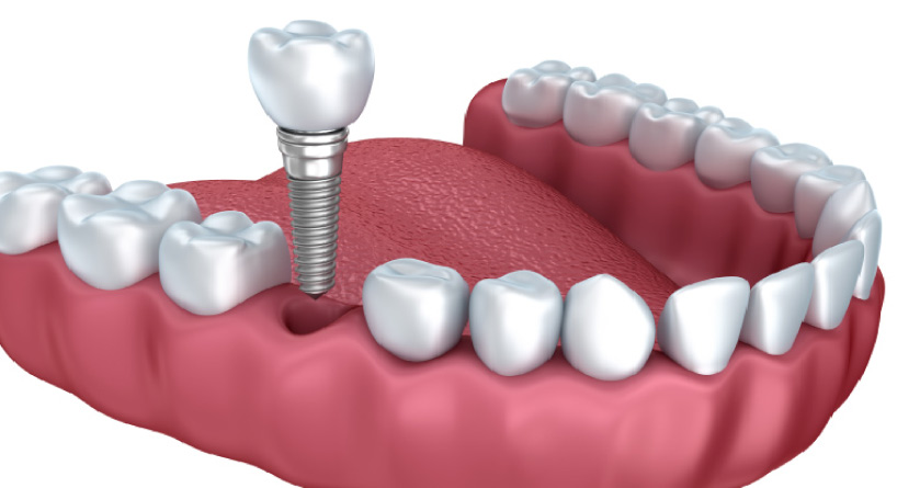 dental implant procedure model