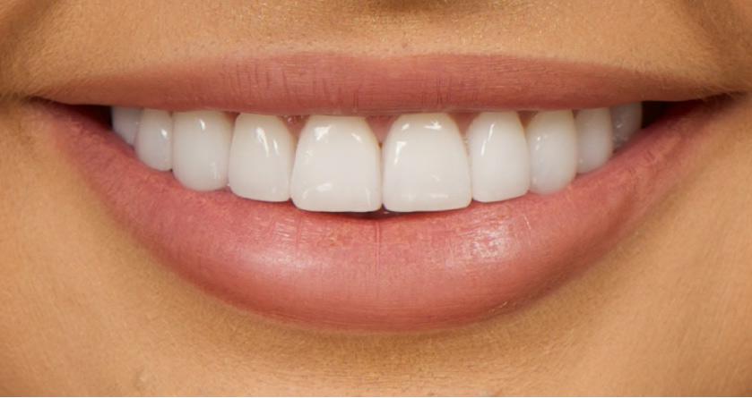 woman's smile showing dental veneers