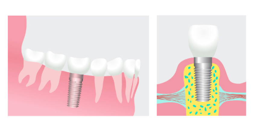 illustration showing how dental implants are placed