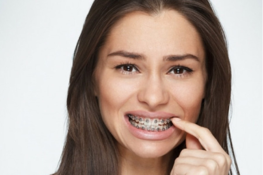 young woman with braces picks food out of the wires