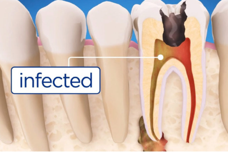 illustration of an infected tooth root needing root canal therapy