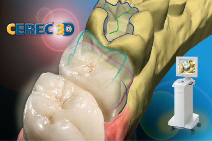 CEREC same day crown dental technology