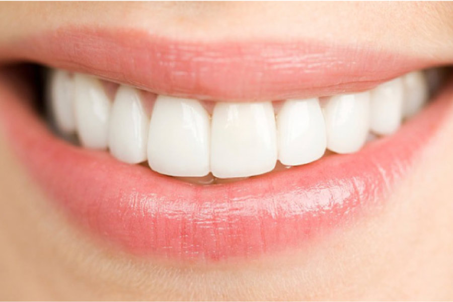 dental veneers smiles