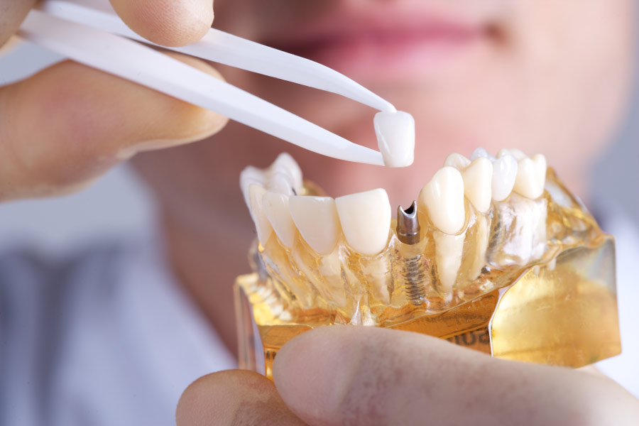 technician holds a dental implant model