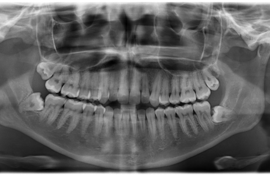 mouth x-ray showing teeth that need attention from a dentist